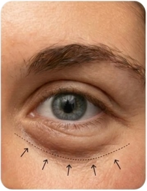 Puffiness shifted