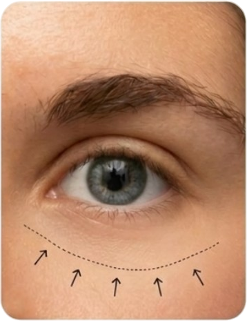 After Full Treatment