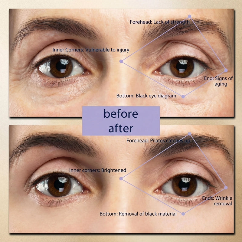 AluneLift PRO EyePods